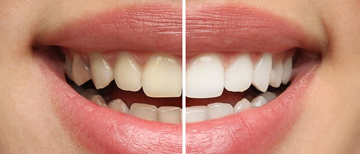 Teeth whitening East Grand Rapids MI cosmetic dentist